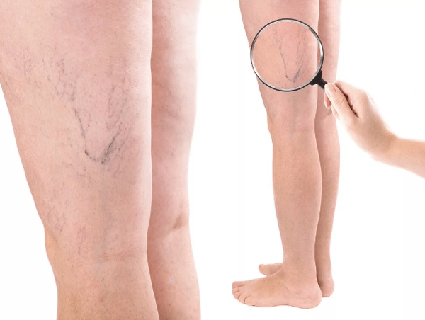 Varizes veias em mulheres