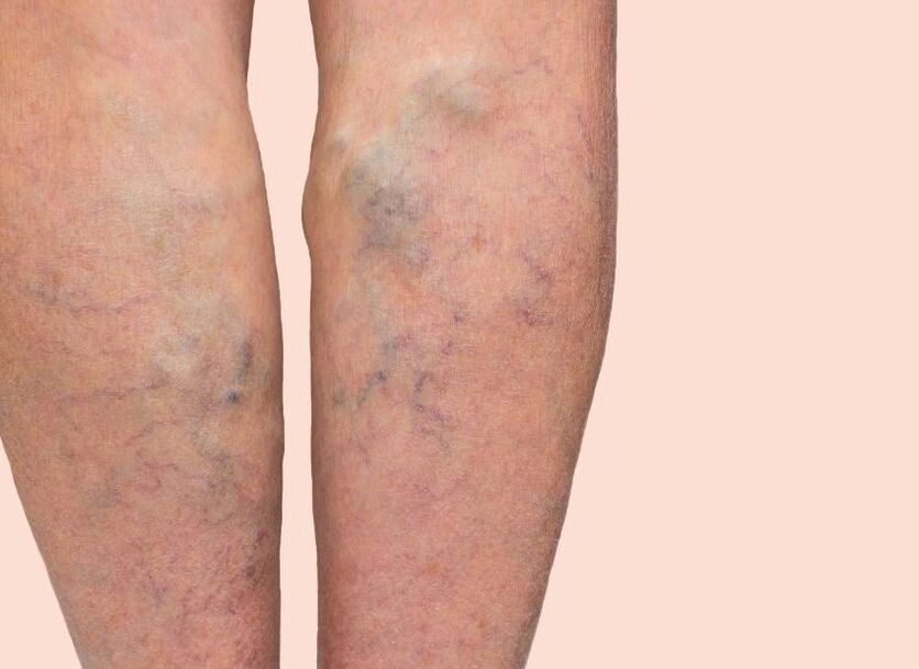 Como são as varizes veias