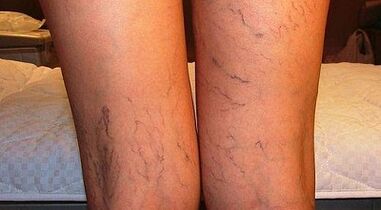 Como tratar a expansão da varicona em mulheres em mulheres