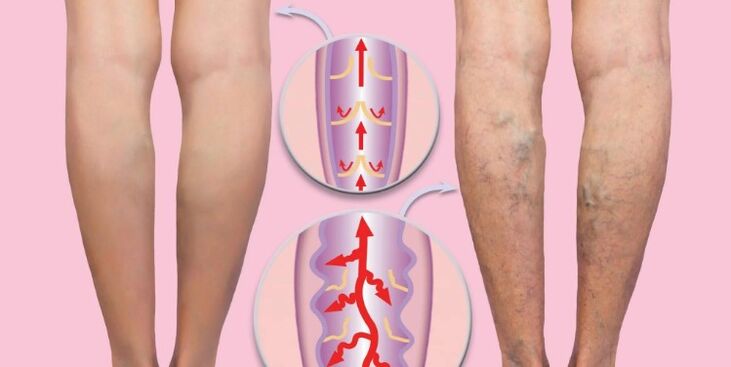 veias saudáveis ​​e varicosas na perna