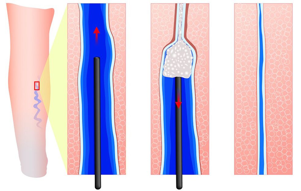 Mecanismo de escleroterapia